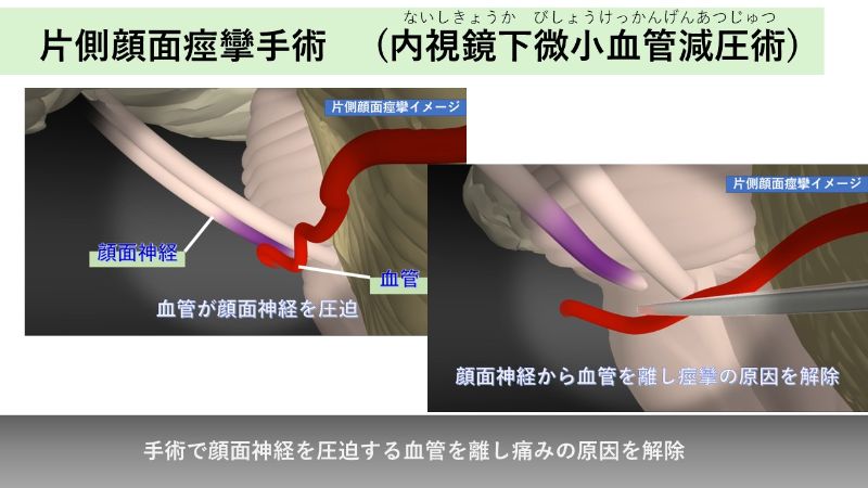 片側顔面痙攣の手術イメージ