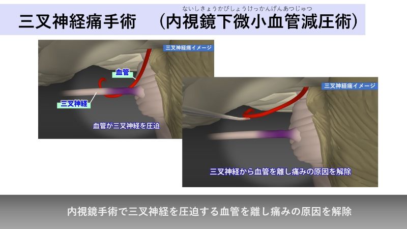 三叉神経痛の手術イメージ